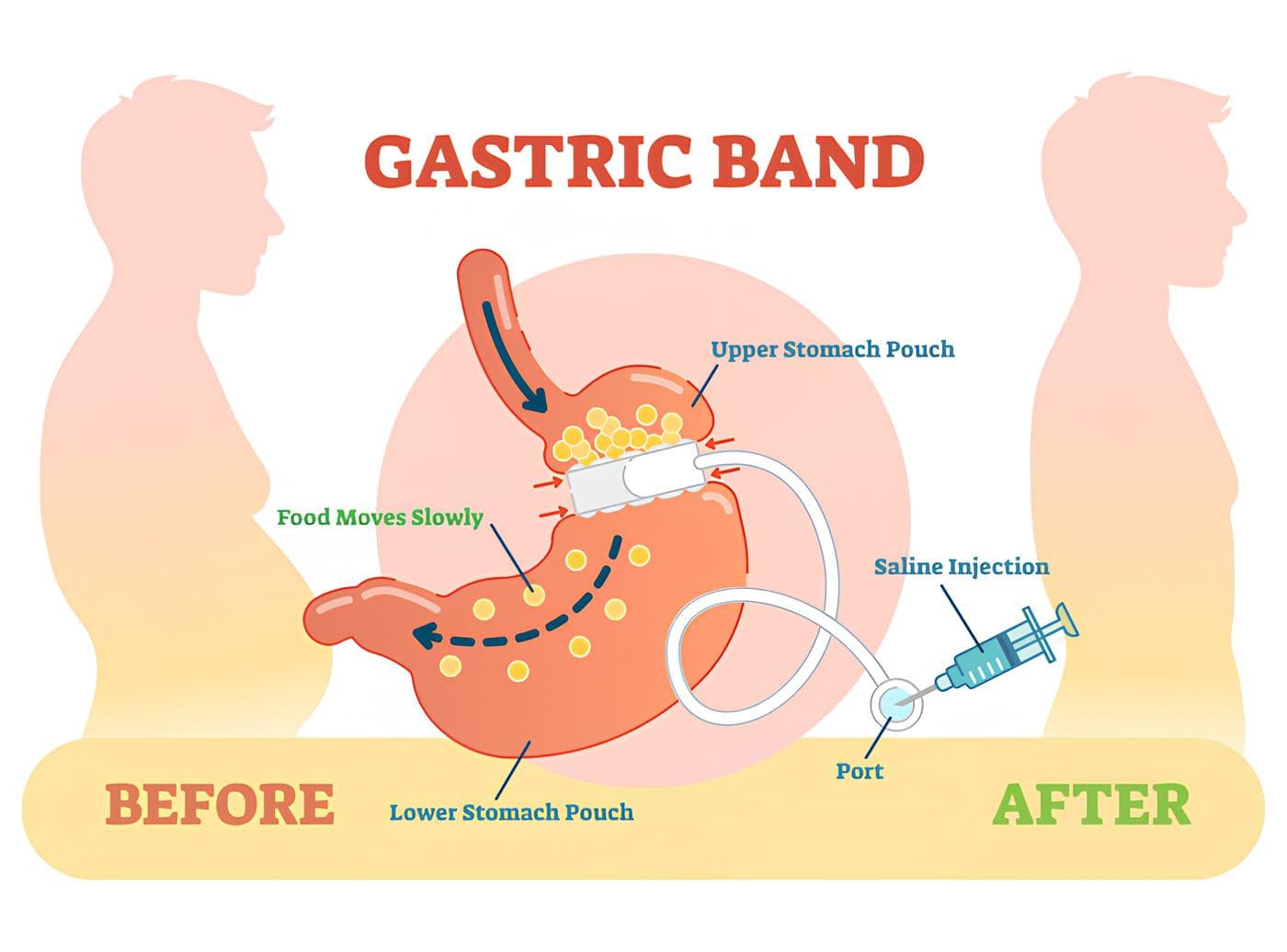 bendaggio gastrico regolabile SICOB Amici Obesi