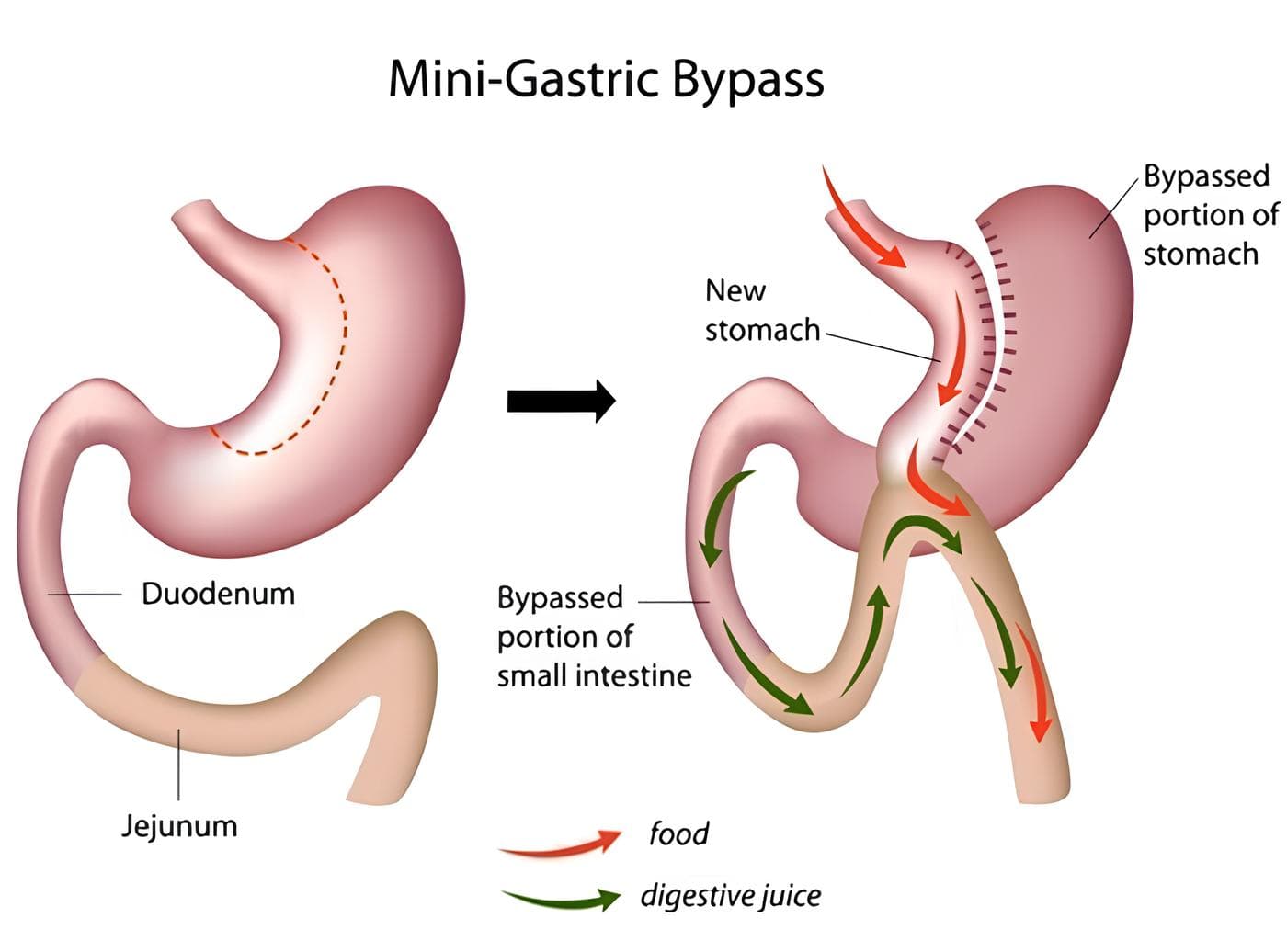 mini gastric bypass source sicob