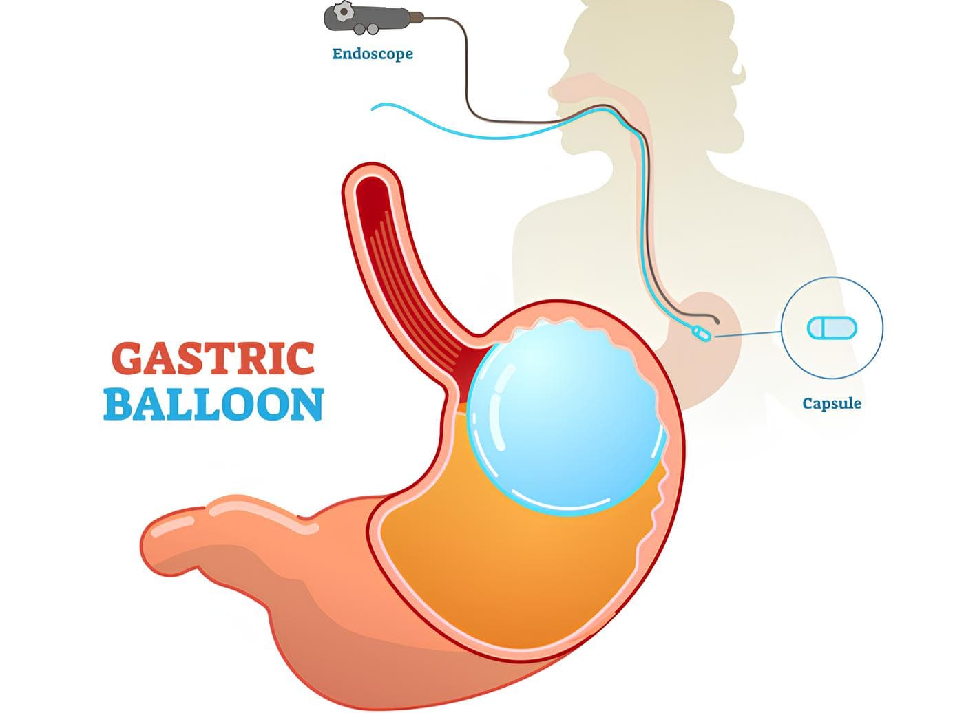 Pallone Intragastrico Sicob Amici Obesi